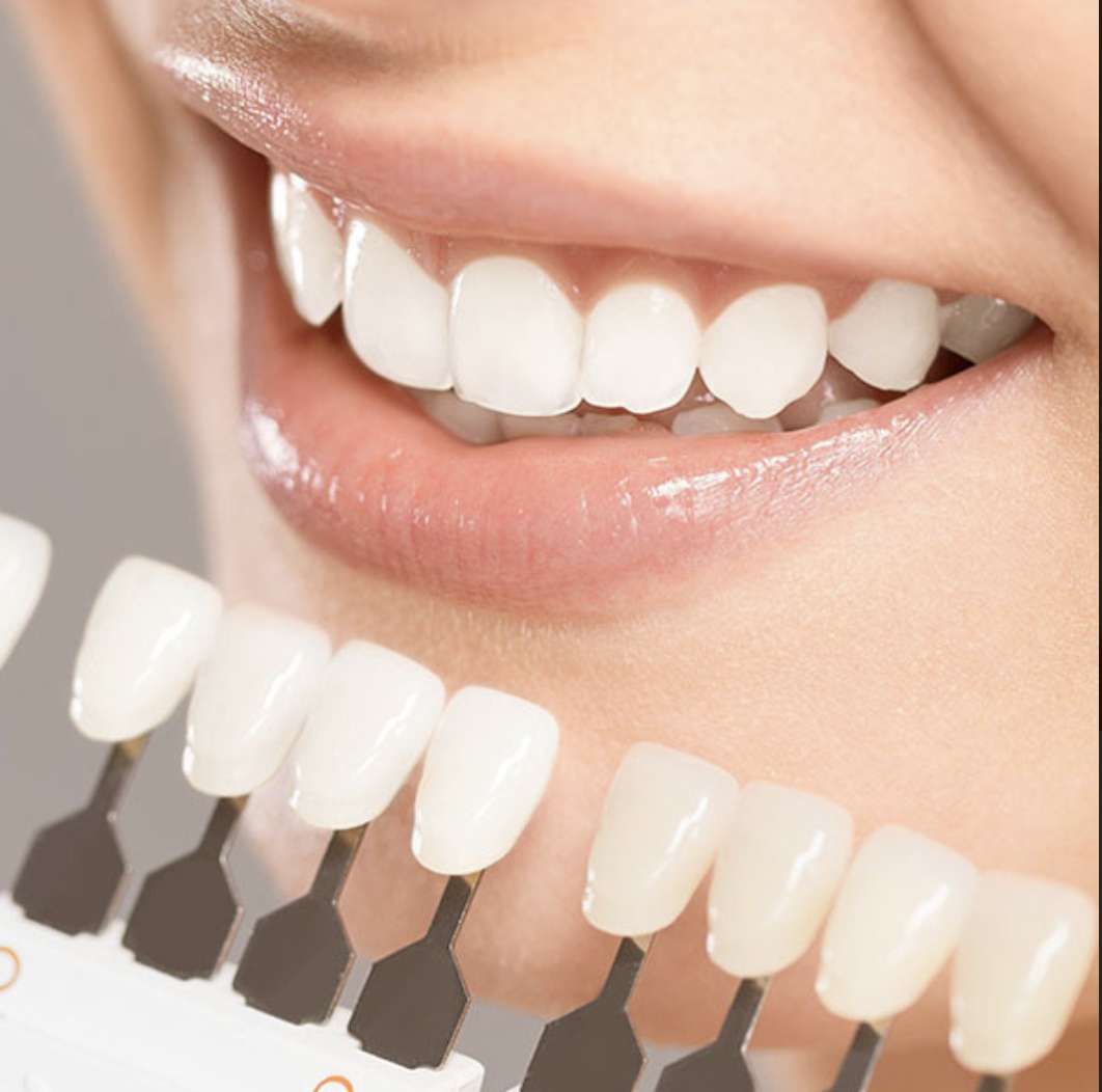 歯の着色汚れの原因とは？綺麗な白い歯になるためのポイントとは？-2-